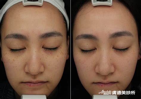 臉上黑斑|黑斑 (Melasma)